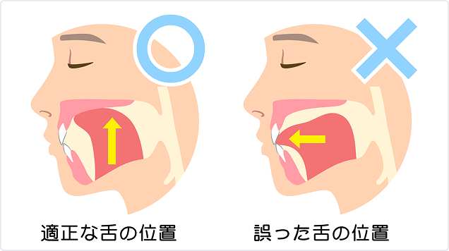 歯並びに影響する舌の位置